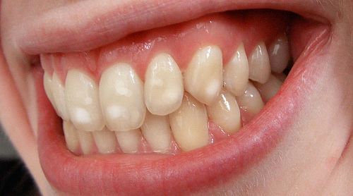 What Are The White Spots On My Teeth? A Kelowna Dentist Explains
